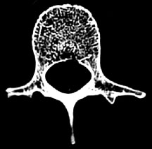 Vertebra: 